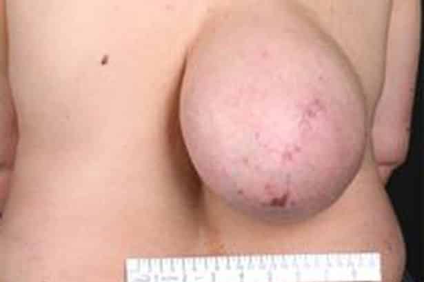 Woman_grows_boob-shaped_tumour_the_size_of_bowling_ball_on_her_back_for_10_years