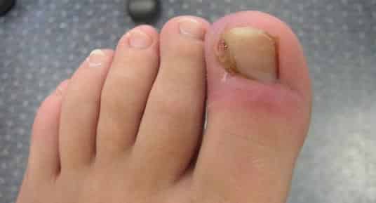 fingernail infection #11