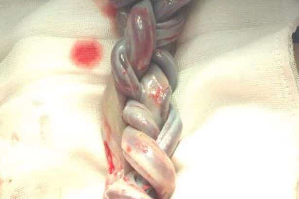 Mum_shares_incredible_Facebook_picture_of_rare_MoMo_twins_knotted_umbilical_cords_after_they_defied_doctors_to_survive