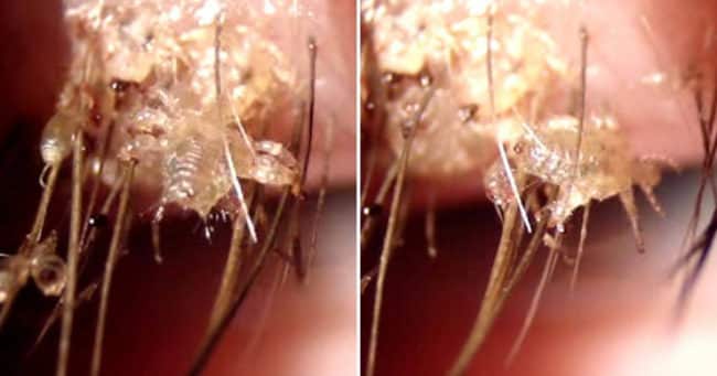 This_horrifying_close-up_video_of_eyelash_lice_will_give_you_nightmares