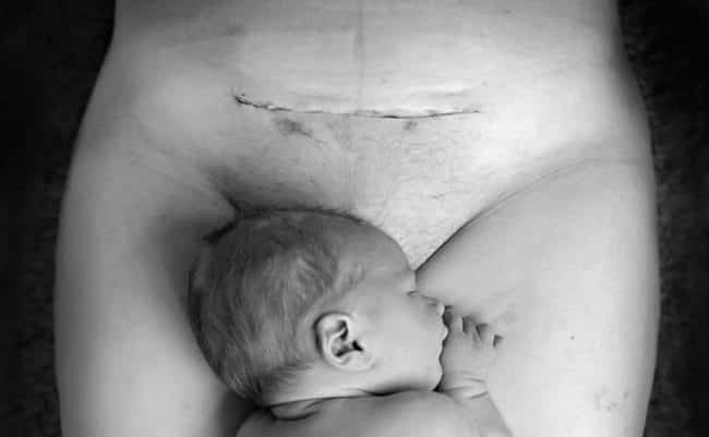 Photo_Of_Baby_Lying_Next_To_Mom’s_C-Section_Scar_Shows_Us_What_Mothers_Go_Through