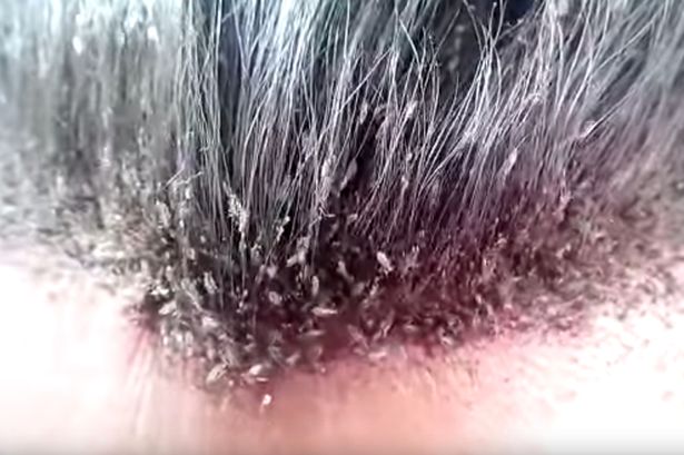 This_video_of_a_mans_disgusting_head_lice_infestation_will_make_your_skin_crawl