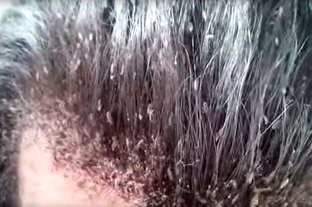 This_video_of_a_mans_disgusting_head_lice_infestation_will_make_your_skin_crawl1